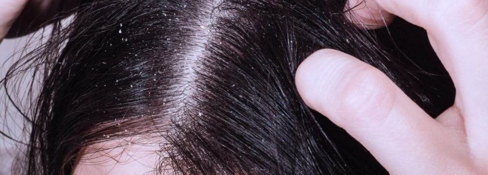 Новости и полезная информация » Причины себореи кожи головы у женщин